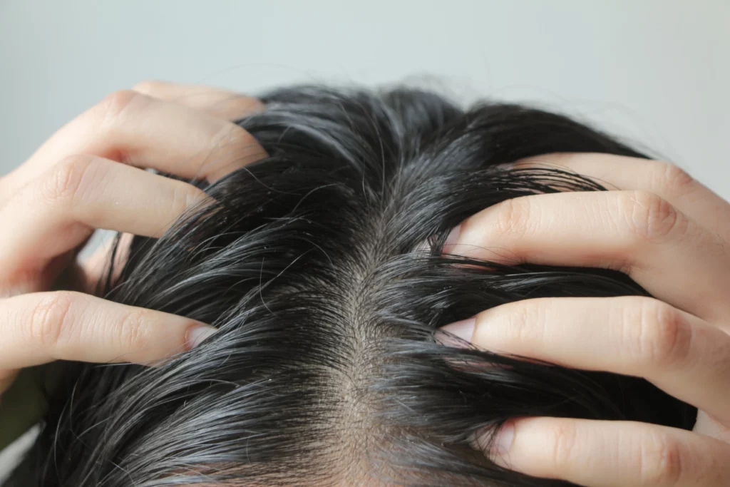 Scalp damaged by harsh shampoo